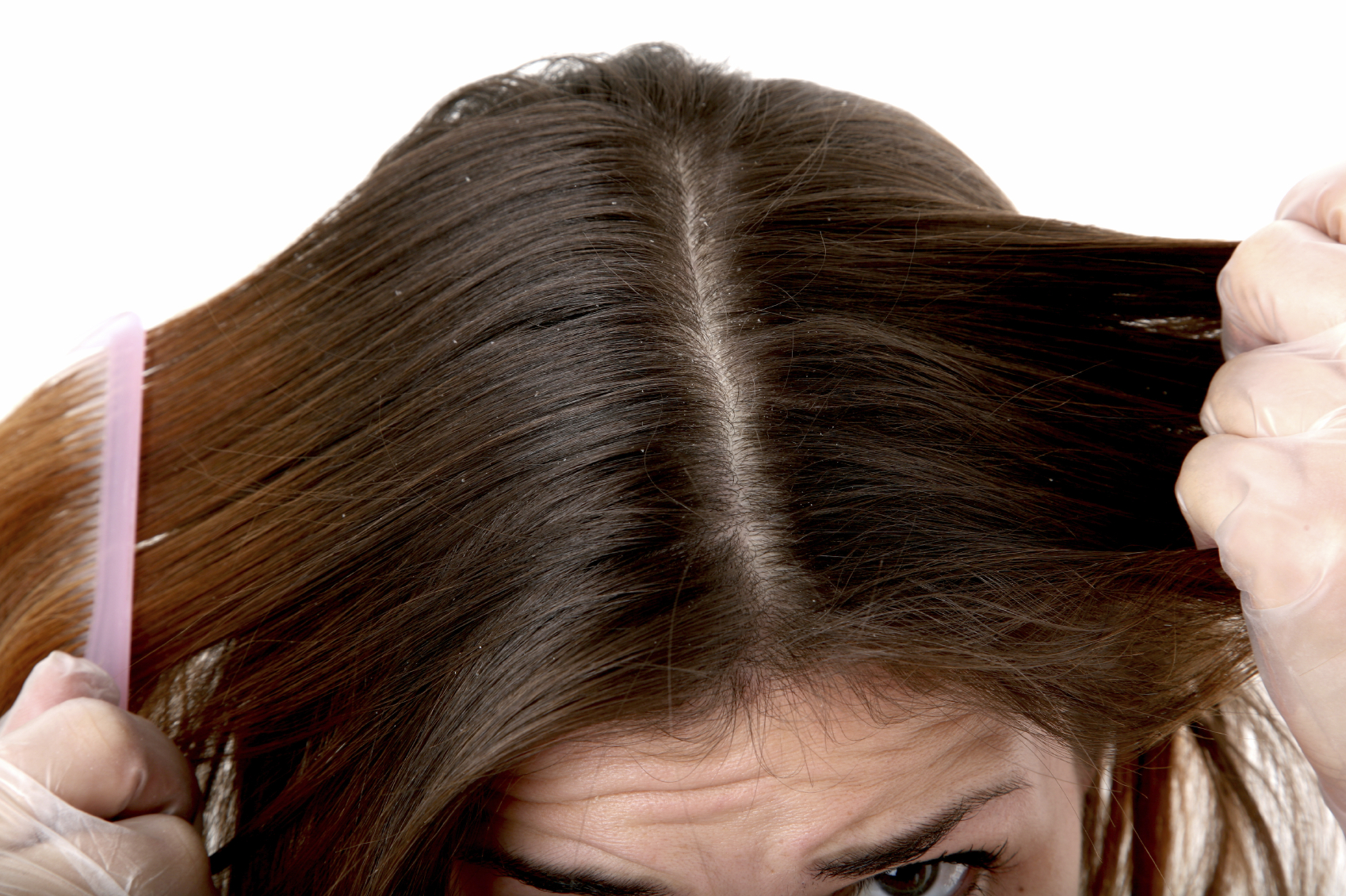 Foods To Keep Dandruff Away